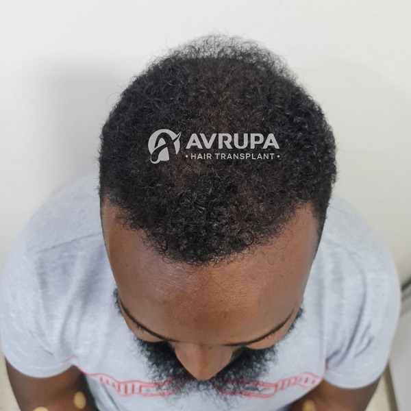 Approccio specializzato per trapianto di capelli afro e follicoli ricci