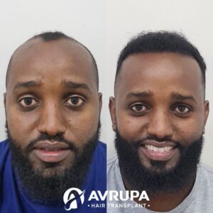 Risultato trapianto FUE afro per capelli ricci a Istanbul in Turchia