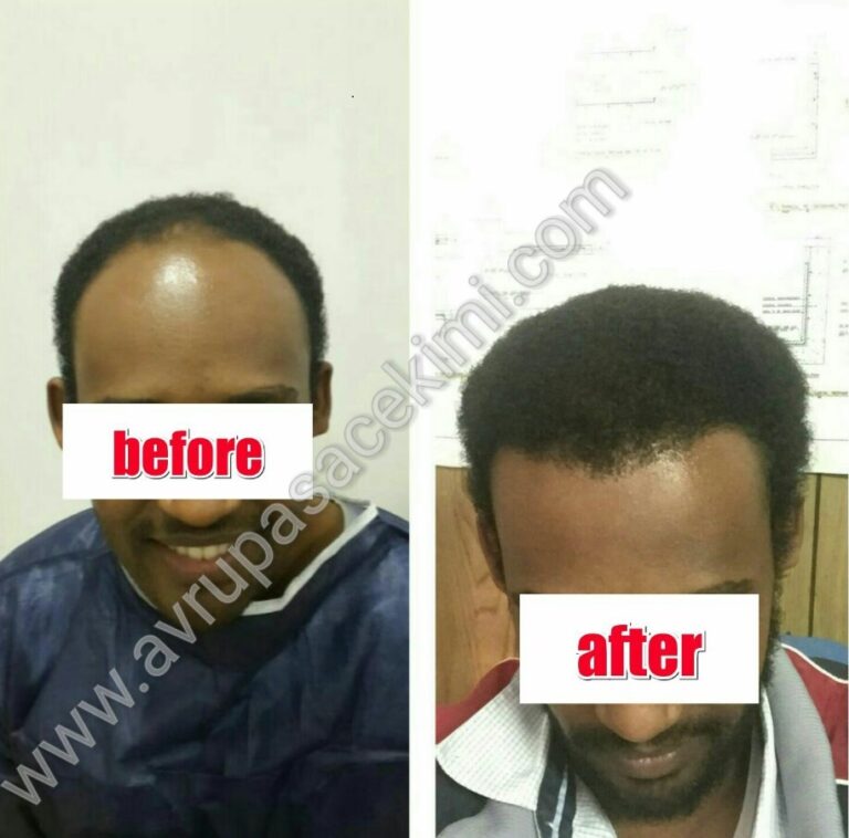 Afro hair transplant Turkey before and after photo showing improved density