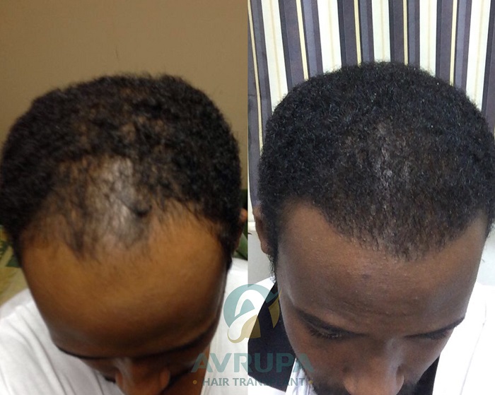 Afro hair transplant Turkey before and after result showing natural hairline restoration