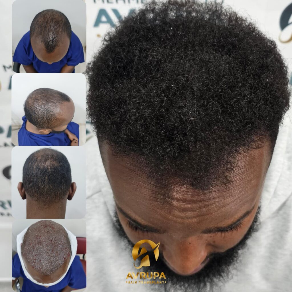Risultato prima e dopo trapianto di capelli afroamericani in Turchia