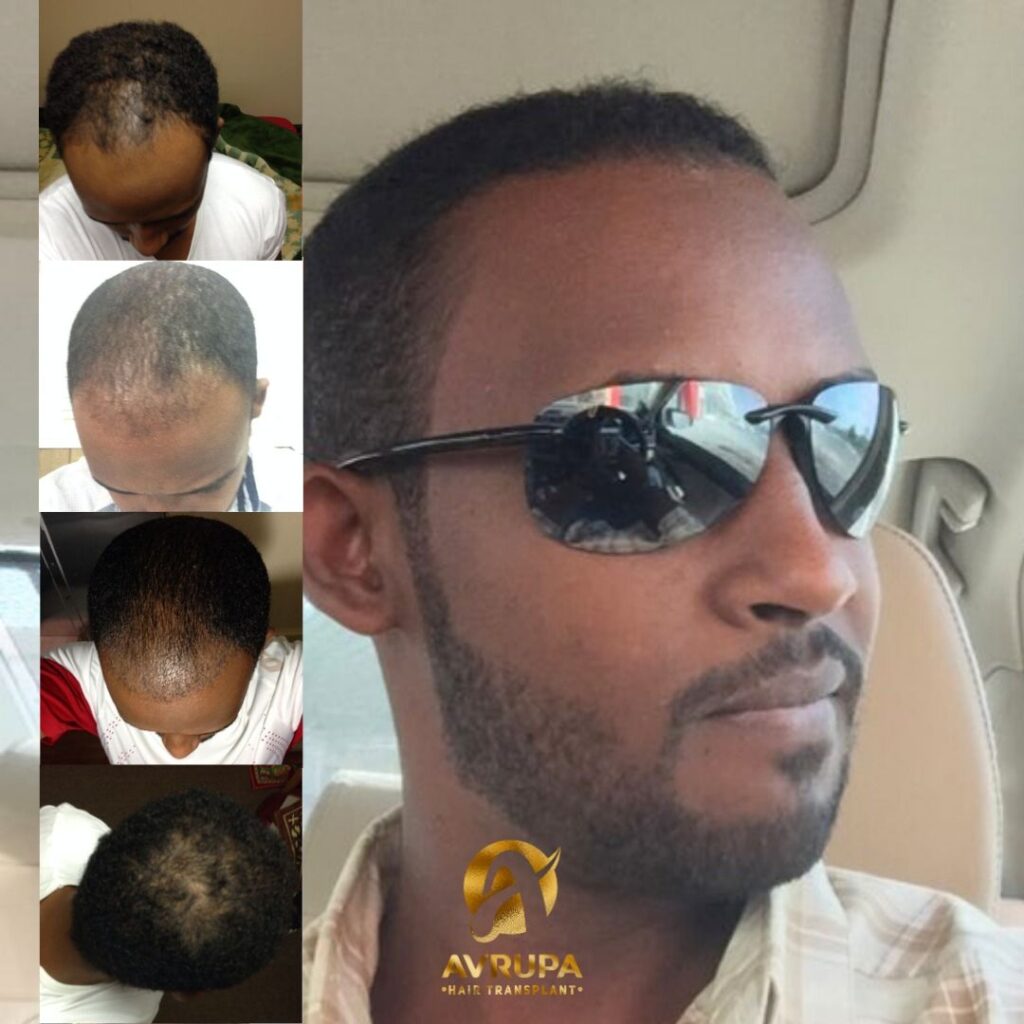 Risultato prima e dopo trapianto di capelli afro in Turchia dopo 8 mesi